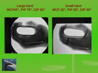 Large hand  Small hand MCP45 °, PIP 75°, DIP 80°  MCP 20°, PIP 80°, DIP 80° 