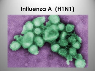 Influenza A (H1N1)
 