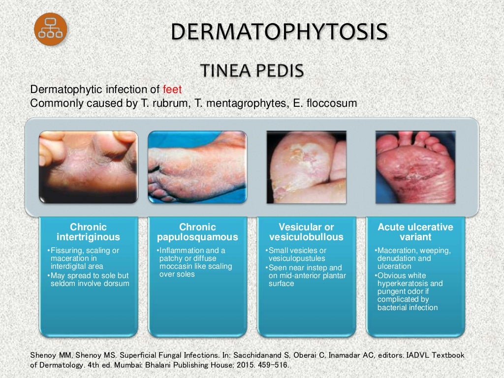 Oral Griseofulvin in Dermatology