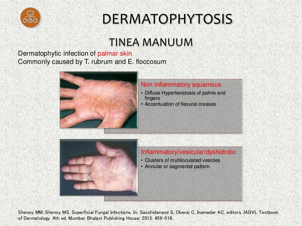 Oral Griseofulvin in Dermatology