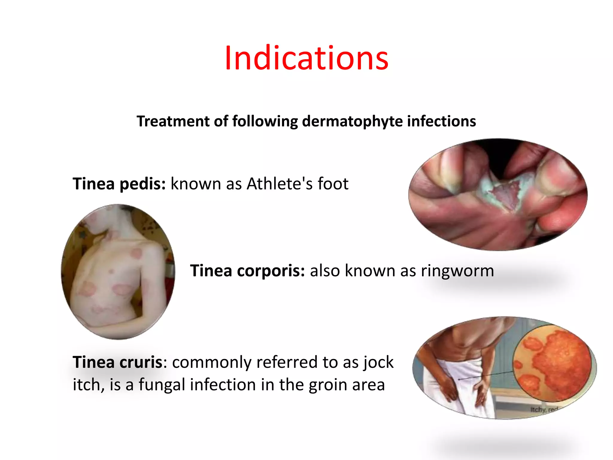 Indications
Treatment of following dermatophyte infections
Tinea cruris: commonly referred to as jock
itch, is a fungal infection in the groin area
Tinea corporis: also known as ringworm
Tinea pedis: known as Athlete's foot
 