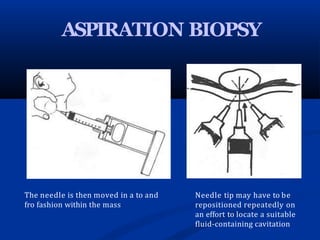 ASPIRATION BIOPSY
The needle is then moved in a to and
fro fashion within the mass
Needle tip may have to be
repositioned repeatedly on
an effort to locate a suitable
fluid-containing cavitation
 