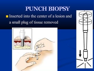 PUNCH BIOPSY
■ Inserted into the center of a lesion and
a small plug of tissue removed
 