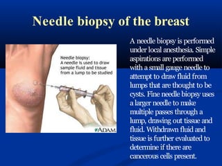 Needle biopsy of the breast
A needle biopsy is performed
under local anesthesia. Simple
aspirations are performed
with a small gauge needle to
attempt to draw fluid from
lumps that are thought to be
cysts. Fine needle biopsy uses
a larger needle to make
multiple passes through a
lump, drawing out tissue and
fluid. Withdrawn fluid and
tissue is further evaluated to
determine if there are
cancerous cells present.
 