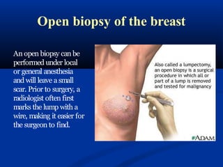 Open biopsy of the breast
An open biopsy can be
performed under local
or general anesthesia
and will leave a small
scar. Prior to surgery, a
radiologist often first
marks the lump with a
wire, making it easier for
the surgeon to find.
 