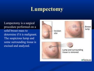 Lumpectomy
Lumpectomy is a surgical
procedure performed on a
solid breast mass to
determine if it is malignant.
The suspicious lump and
some surrounding tissue is
excised and analyzed.
 
