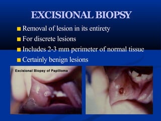 EXCISIONAL BIOPSY
■ Removal of lesion in its entirety
■ For discrete lesions
■ Includes 2-3 mm perimeter of normal tissue
■ Certainly benign lesions
 