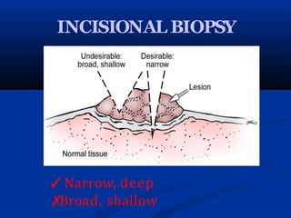 INCISIONAL BIOPSY
✓Narrow, deep
✗
Broad, shallow
 