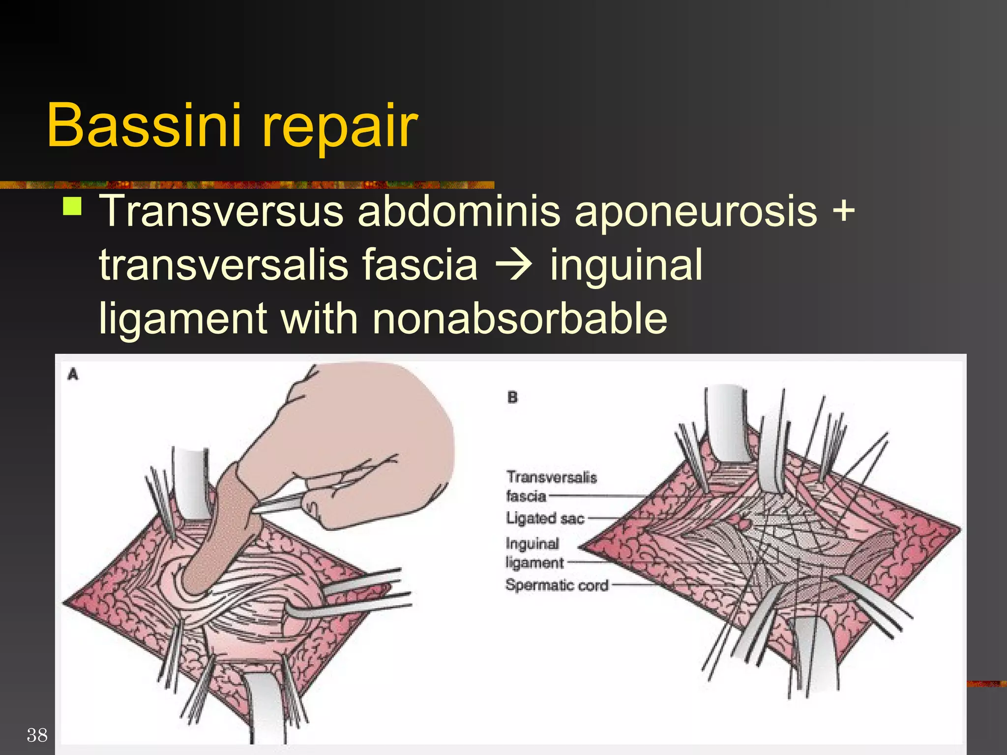 Mcvay Incision Groin hernia 4th year | PPT | Death, Injury, or Military Conflict ...