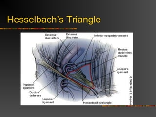 Hesselbach’s Triangle
 