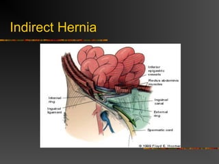 Indirect Inguinal hernia
 Abdominal contents protrude through internal inguinal
ring
 