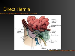 Indirect Hernia
 