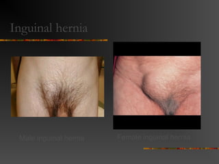 Anatomy
 Direct hernias are usually not congenital.
 Acquired by the development of tissue
deficiencies of the transversalis fascia.
 Development of femoral hernia less
understood. Can result from increased
intraabdominal pressure. The sac then
migrates down the femoral vessels into
thigh.
 