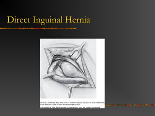 Anatomy Inguinal ligament
(Poupart’s) – inferior edge
of external oblique
 Lacunar ligament –
triangular extension of the
inguinal ligament before
its insertion upon the pubic
tubercle
 conjoined tendon (5-10%)-
Internal oblique fuses with
transversus abdominis
aponeurosis
 Cooper’s Ligament -
formed by the periosteum
and fascia along the
superior ramus of the pubis.
 