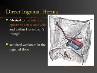 Inguinal hernia
Male inguinal hernia Female inguinal hernia
 