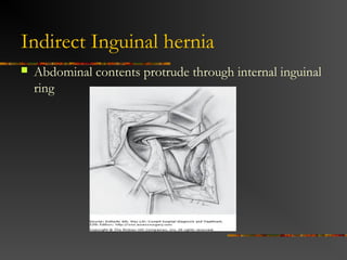 Nyhus Classification
 I indirect, internal ring normal (kids)
 II indirect, dilated internal ring
 III posterior wall defects, direct inguinal
hernia, dilated internal ring, massive
scrotal, sliding, femoral hernia
 IV recurrent hernia
 