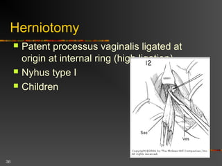 36
Bassini repair
 Transversus abdominis aponeurosis +
transversalis fascia  inguinal
ligament with nonabsorbable
interrupted sutures
 