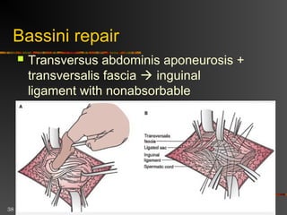 38
McVay repair
 Inguinal and femoral hernias,
Transversus abdominis aponeurosis +
transversalis fascia  Cooper’s
ligament + iliopubic tract
 