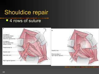 39
Hernioplasty
 High ligation, inverted sac + reinforce
defect with synthetic material
 Tension-free
 Lichtenstein
 Recurrent rate 0.1%
 