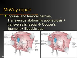 Tension-Free Repair
 Same initial approach as anterior repair
 Instead of sewing fascial layers together
to repair defect, a prosthetic mesh onlay
used
 Simple to learn, easy to perform, suited for
local anesthesia, excellent results with
recurrence less than 4%.
 