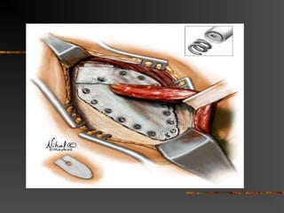 Techniques
 Coined by Liechtenstein in 1989
 Central feature is polypropylene mesh
over unrepaired floor.
 Gilbert repair uses a cone shaped plug
placed thru deep ring.
 Slit placed in mesh for cord structures
 