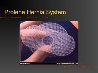 Laparoscopic Mesh Repair
Note:
Viewed from inside the
pelvis toward the direct
and indirect sites. A
broad portion of mesh is
stapled to span both
hernia defects. Staples
are not used in
proximity to
neurovascular
structures.
 