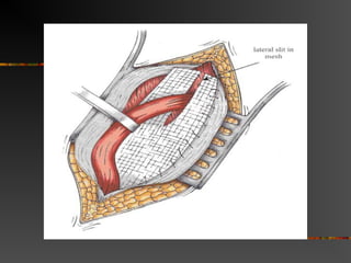Recurrence
Type of repair Recurrence
McVay 9%
Shouldice 7-11%
Liechtenstein 0-4%
Laparoscopic 0-1%
 