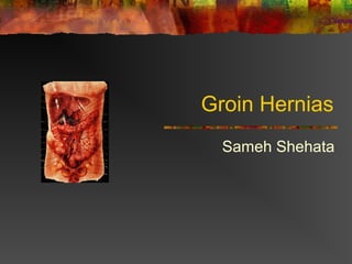 Groin Hernias
Sameh Shehata
 