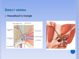 DIRECT HERNIA
 Hesselbach’s triangle
 