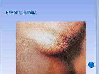 FEMORAL HERNIA
 