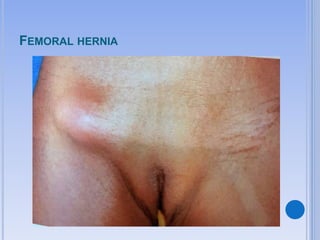 FEMORAL HERNIA
 