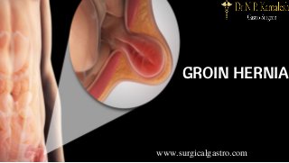 GROIN HERNIA
www.surgicalgastro.com
 