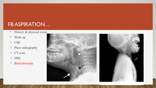 FB ASPIRATION. ..
• History & physical exam
• Work up
o CBC
o Plain radiography
o CT scan
o MRI
o Bronchoscopy
 