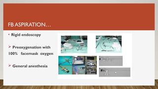 FB ASPIRATION…
• Rigid endoscopy
 Preoxygenation with
100% facemask oxygen
 General anesthesia
 