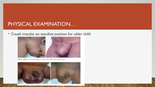 PHYSICAL EXAMINATION. . .
• Cough impulse on standing position for older child
 