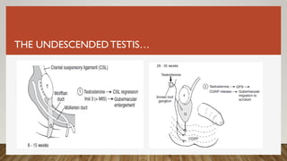 THE UNDESCENDEDTESTIS…
 