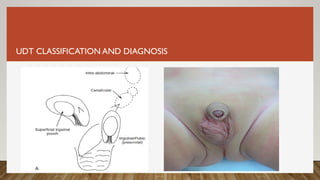UDT CLASSIFICATION AND DIAGNOSIS
 