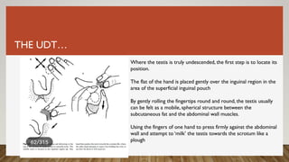 THE UDT…
Where the testis is truly undescended, the first step is to locate its
position.
The flat of the hand is placed gently over the inguinal region in the
area of the superficial inguinal pouch
By gently rolling the fingertips round and round, the testis usually
can be felt as a mobile, spherical structure between the
subcutaneous fat and the abdominal wall muscles.
Using the fingers of one hand to press firmly against the abdominal
wall and attempt to ‘milk’ the testis towards the scrotum like a
plough
 