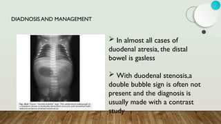 DIADNOSIS AND MANAGEMENT
 In almost all cases of
duodenal atresia, the distal
bowel is gasless
 With duodenal stenosis,a
double bubble sign is often not
present and the diagnosis is
usually made with a contrast
study
 