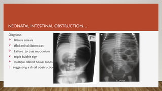 NEONATAL INTESTINAL OBSTRUCTION…
Diagnosis
 Bilious emesis
 Abdominal distention
 Failure to pass muconium
 triple bubble sign
 multiple dilated bowel loops
• suggesting a distal obstruction
 