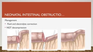 NEONATAL INTESTINAL OBSTRUCTIO…
Management
• Fluid and electrolyte correction
• NGT decompression
 