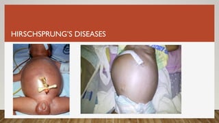 HIRSCHSPRUNG’S DISEASES
 