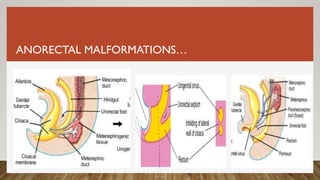ANORECTAL MALFORMATIONS…
 