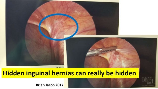 Hernia Enetmd