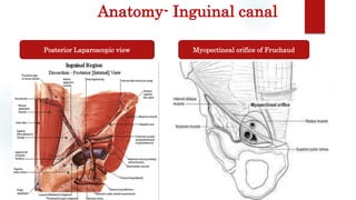 Anatomy- Inguinal canal
Myopectineal orifice of FruchaudPosterior Laparoscopic view
 