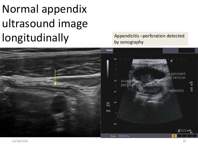 Gross anatomy & histology of ileum, jejunum