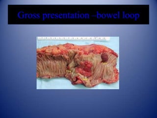 Gross presentation –bowel loop

 