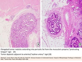 Hwang C, Lee S, Kim A, Kim YG, Ahn SJ, Park DY. Venous Invasion in Colorectal Cancer: Impact of Morphologic Findings on Detection
Rate. Cancer Res Treat. 2016;48(4):1222-1228.
Elongated tumor nodules extending into pericolic fat from the muscularis propria (“protruding
tongue” sign (A)
Tumor deposits adjacent to arteries(“orphan artery” sign) (B)
 