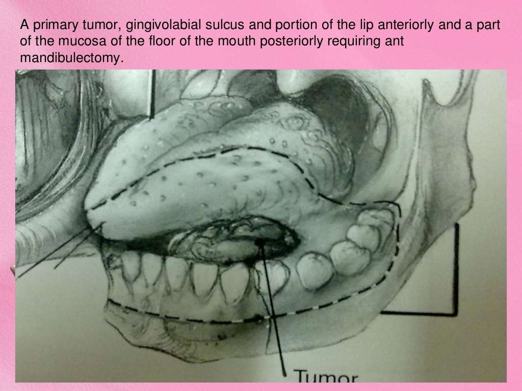 Grossing of mandibulectomy specimen Dr Pranav, MGIMS