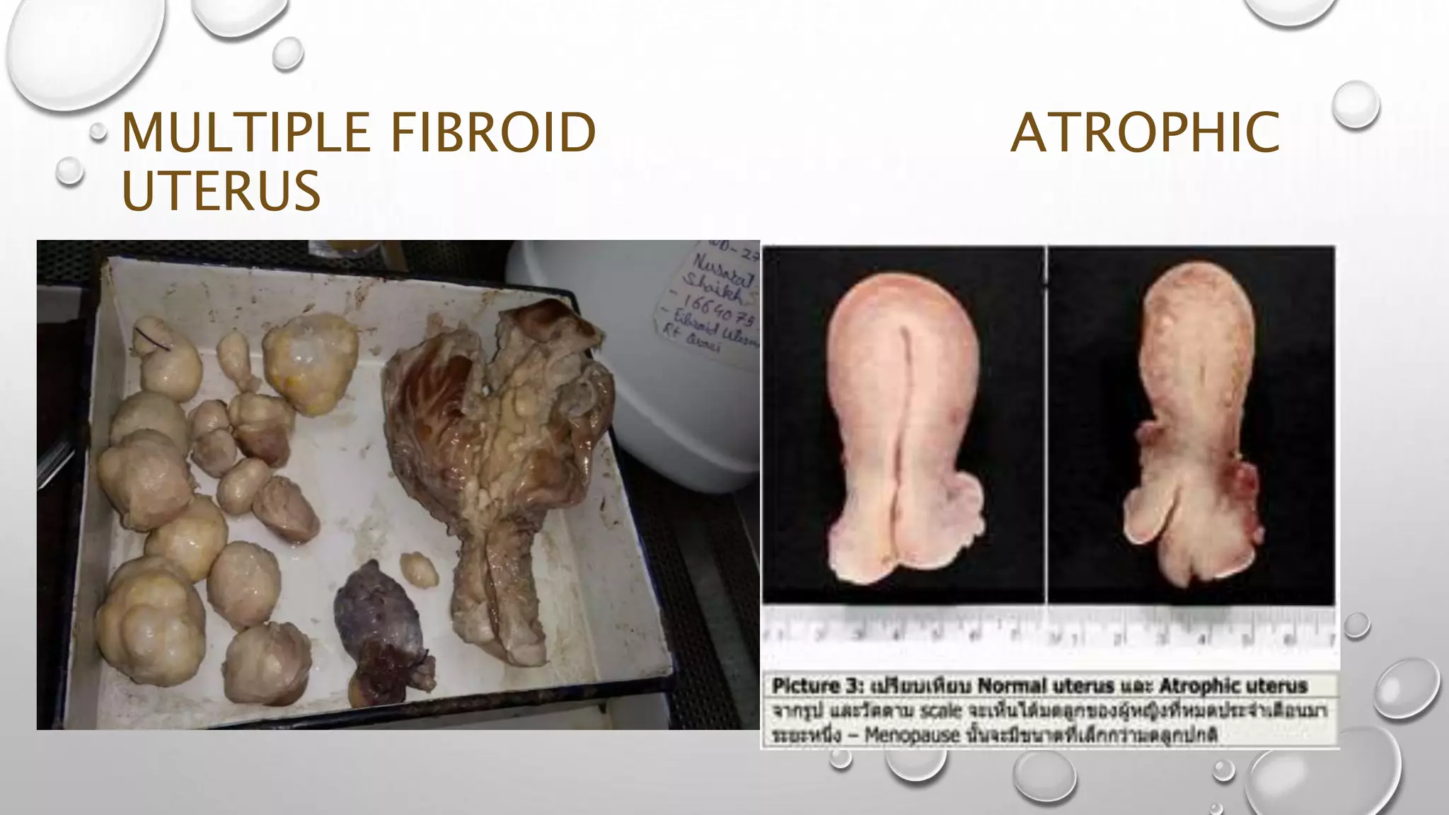 Histopath Grossing of uterus cervix &ovary | PPTX
